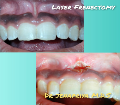 Laser Frenectomy