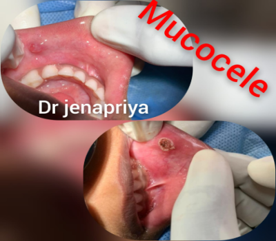Minor Oral surgical procedures