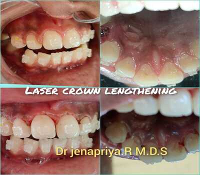 Laser Crown Lengthening