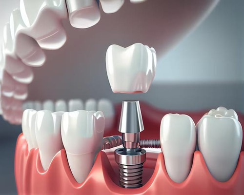 DENTAL IMPLANTS