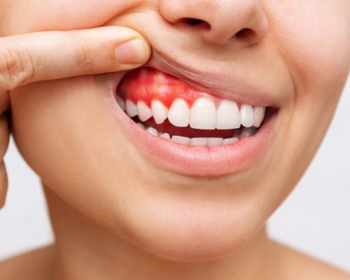PERIODONTITIS